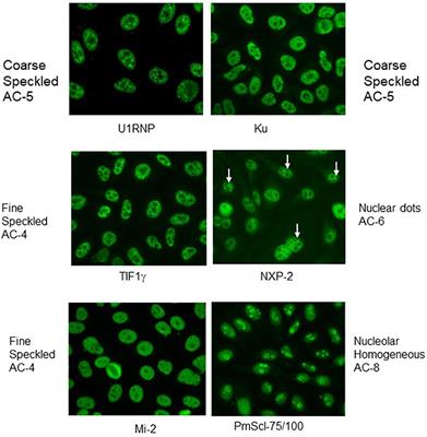 Disease Specific Autoantibodies in Idiopathic Inflammatory Myopathies